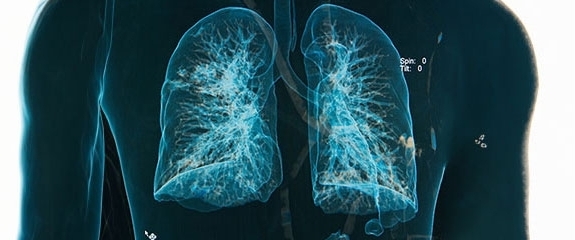 BRONCHIECTASIE E DINTORNI